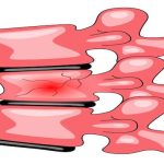 Omurga Kırığı ve Vertebroplasti: Modern Tedavi Yaklaşımı