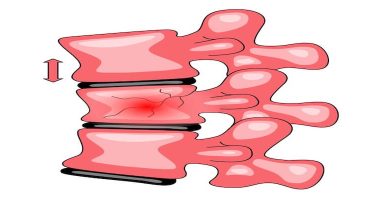 Omurga Kırığı ve Vertebroplasti: Modern Tedavi Yaklaşımı