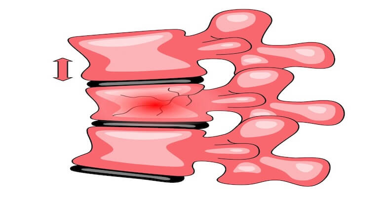 Omurga Kırığı ve Vertebroplasti: Modern Tedavi Yaklaşımı